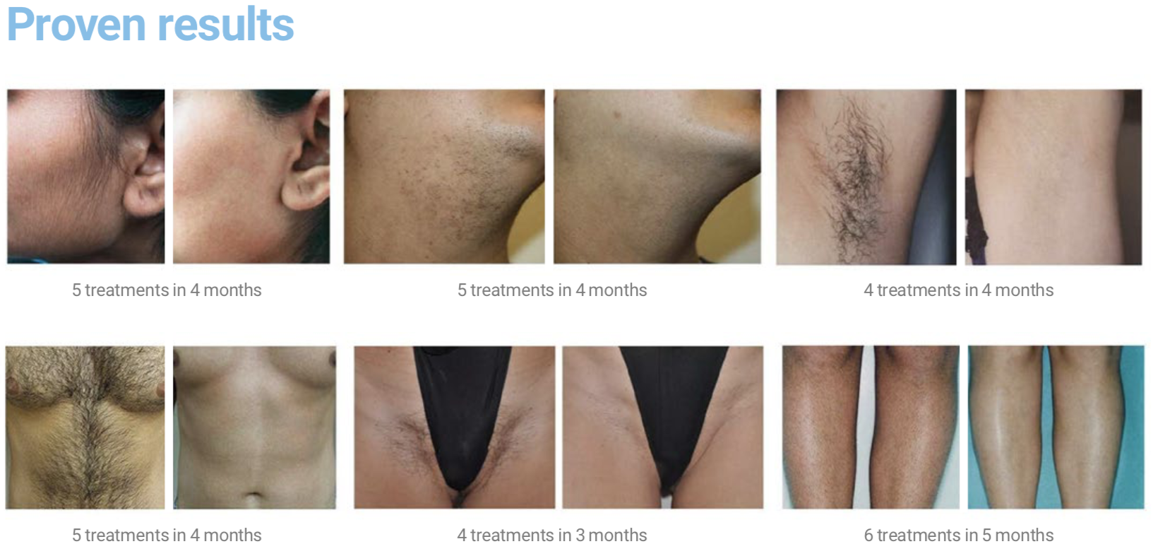 Laser Hair Removal Clinic 55